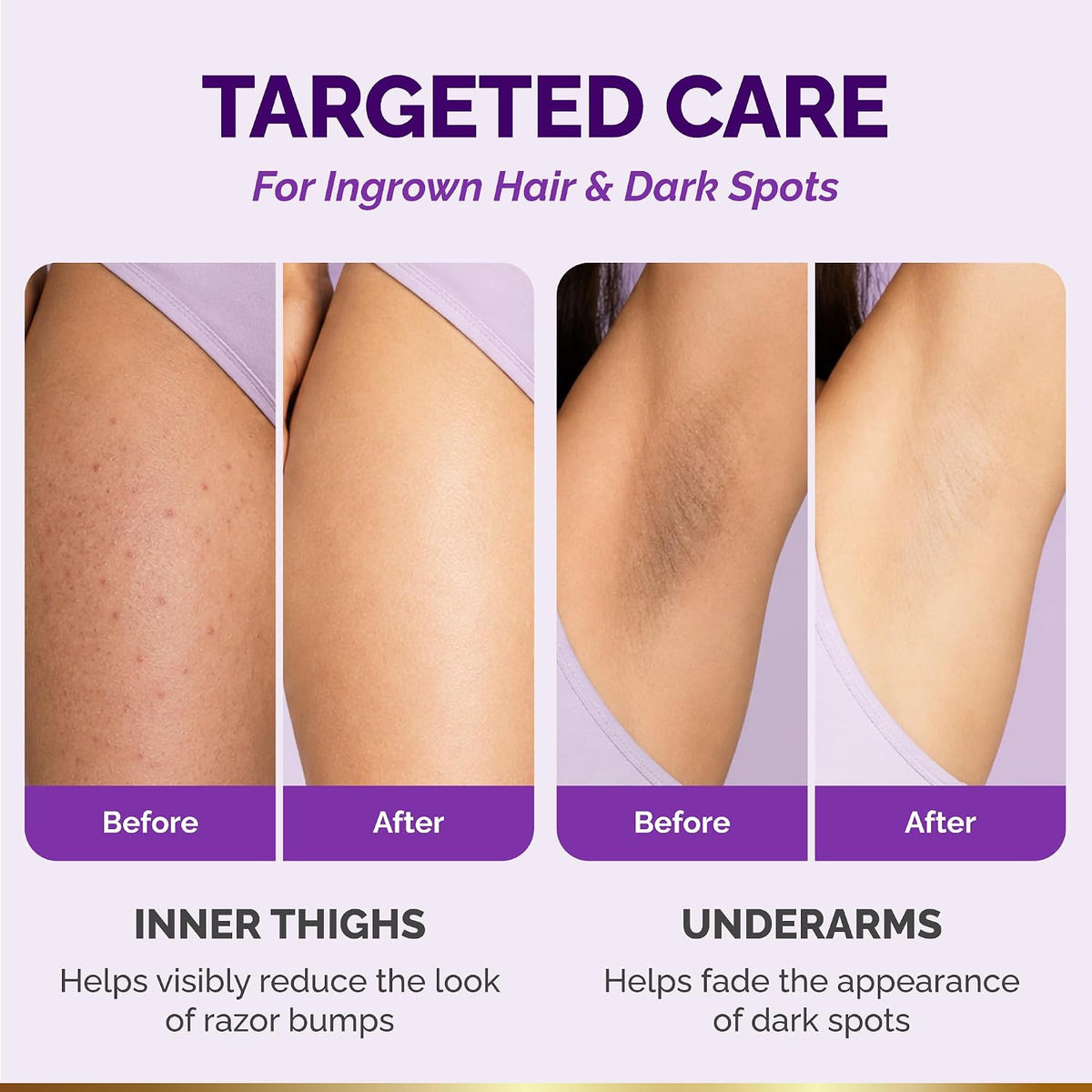 Visual results graphic titled Targeted Care For Ingrown Hair & Dark Spots showing Before and After photos for two areas: Inner Thighs (helps visibly reduce the look of razor bumps) and Underarms (helps fade the appearance of dark spots).
