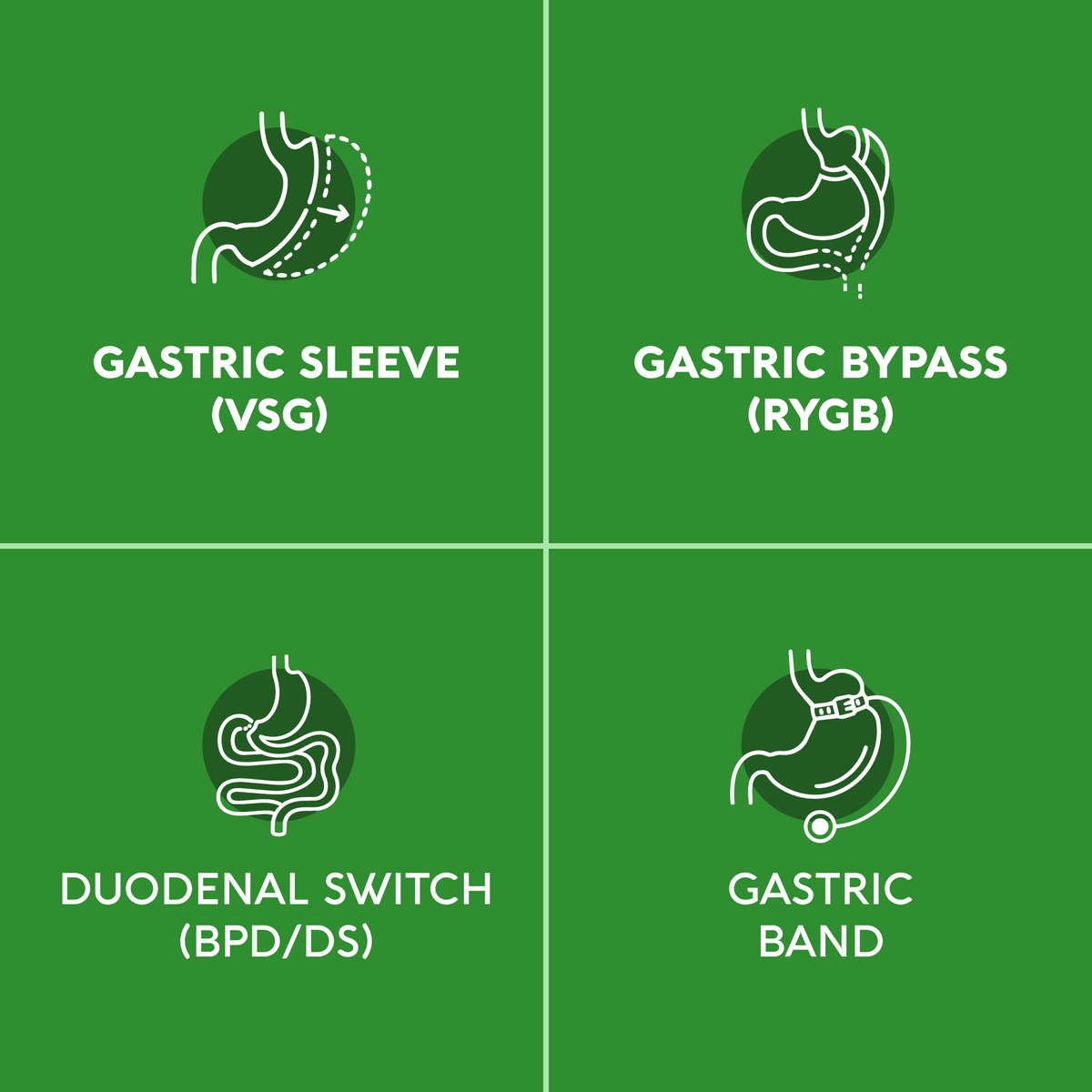 A four-panel graphic illustrating bariatric surgery procedures supported by the product:   Gastric Sleeve (VSG): Designed for post-sleeve gastrectomy nutrition.   Gastric Bypass (RYGB): Suitable for post-Roux-en-Y gastric bypass care.   Duodenal Switch (BPD/DS): Formulated to support biliopancreatic diversion with duodenal switch patients.   Gastric Band: Compatible with lap-band surgical recovery nutrition.   